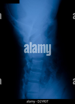 X-ray film of lateral spine Stock Photo