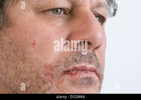 Cold sores on lips Stock Photo