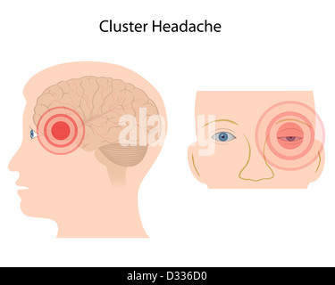 Cluster headache Stock Photo