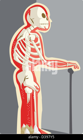 The human skeleton with missing leg bone depicting Osteoporosis Stock Photo