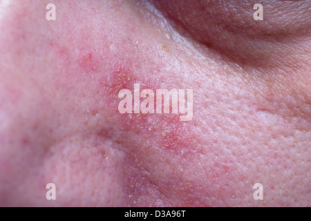 Seborrhoeic dermatitis on the face of a male (40s) Stock Photo