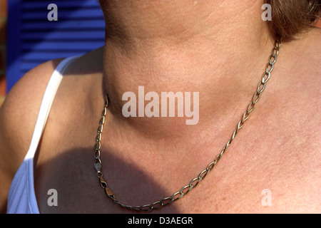 Middle aged woman with a goiter lump Stock Photo