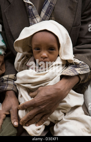 BITENA HEALTH CENTRE, WOLAYITA, ETHIOPIA, 20TH AUGUST 2008: Dampday Dado, has brought his 14 month old malnourished daughter Stock Photo