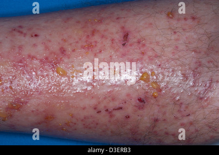 poison ivy dermatis rash on leg Stock Photo