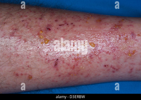 poison ivy dermatis rash on leg Stock Photo