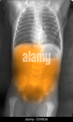 Pyloric Stenosis Abdomen Xray Stock Photo Alamy