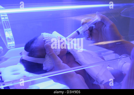 NEONATAL JAUNDICE, PHOTOTHERAPY Stock Photo