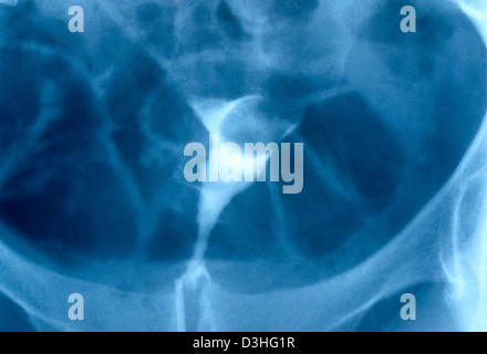 UTERINE FIBROMA, X-RAY Stock Photo