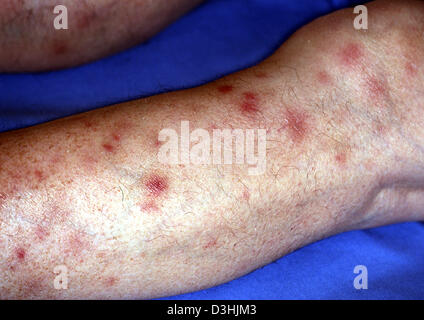 PANNICULITIS Stock Photo: 53862935 - Alamy