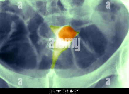 UTERINE FIBROMA, X-RAY Stock Photo