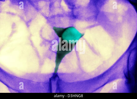 UTERINE FIBROMA, X-RAY Stock Photo