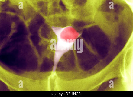 UTERINE FIBROMA, X-RAY Stock Photo