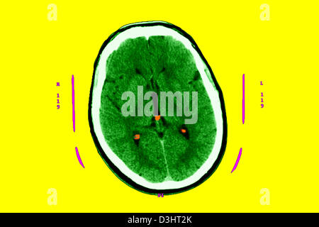 CREUTZFELDT JAKOB DISEASE, MRI Stock Photo