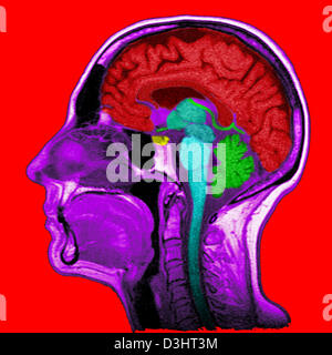 HEAD, MRI Stock Photo