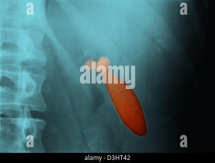 GALLSTONE, X-RAY Stock Photo