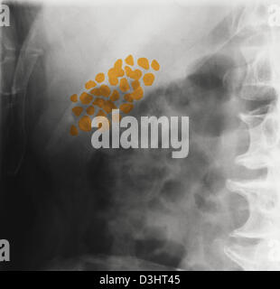 GALLSTONE, X-RAY Stock Photo