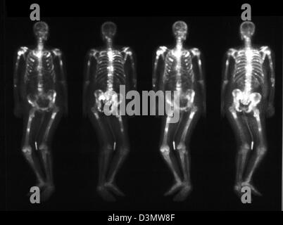 Bone scan showing multiple metastases Stock Photo