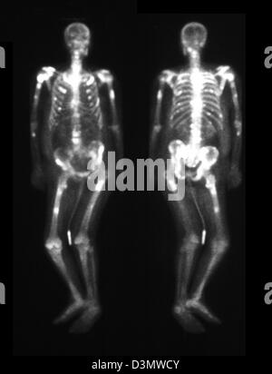 Bone scan showing multiple metastases Stock Photo