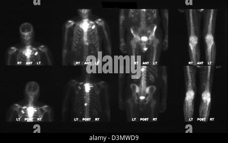 Bone scan showing multiple metastases Stock Photo