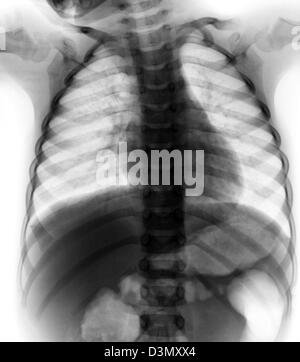 normal chest x-ray of a 3 year old boy Stock Photo - Alamy