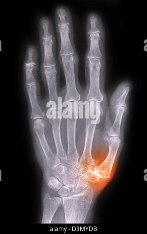 Hand x-ray of an older man showing degenerative arthritic disease at the base of the thumb metacarpal Stock Photo