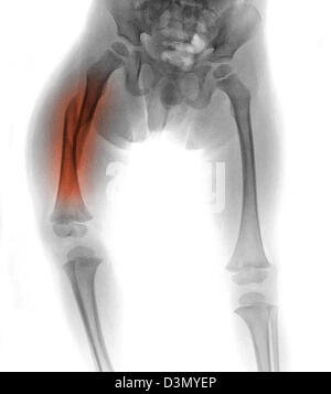 x-ray showing a femur fracture in a 3 year old boy, a victim of child abuse Stock Photo
