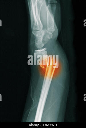 buckle fracture ulna