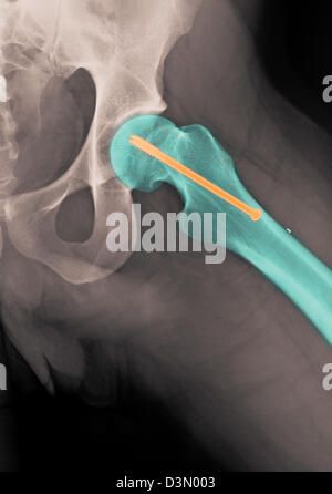 hip x-ray showing the repair of a fractured femur with a screw Stock Photo