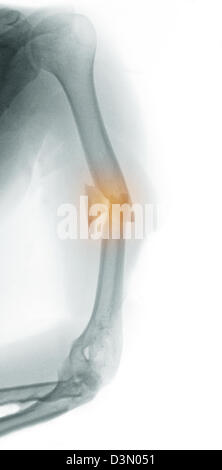 X-ray showing a humerus fracture in a middle aged man involved in a motorcycle accident Stock Photo