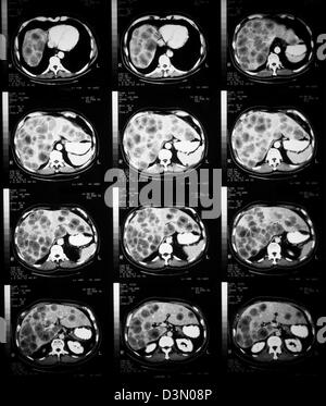 CT scan slices showing extensive metastatic liver cancer Stock Photo ...