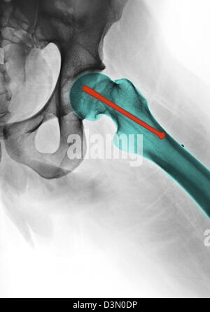 hip x-ray showing the repair of a fractured femur with a screw Stock Photo