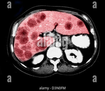 CT scan slices showing extensive metastatic liver cancer Stock Photo ...