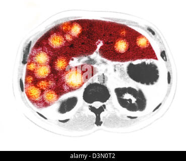 CT scan slices showing extensive metastatic liver cancer Stock Photo ...