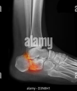 x-ray of a man's foot showing a fracture of the heel Stock Photo