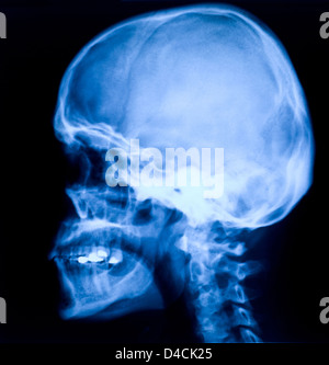 blue image of head xray Stock Photo