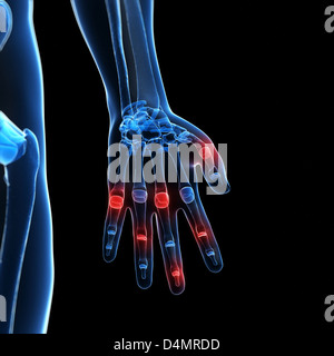 X-ray hand - arthritis Stock Photo