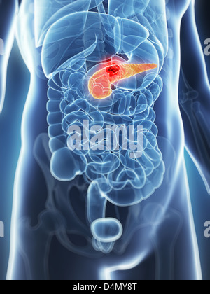 Pancreas - cancer Stock Photo