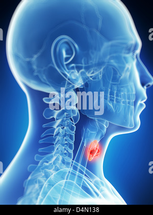 Tumor in human thyroid gland, computer illustration Stock Photo - Alamy