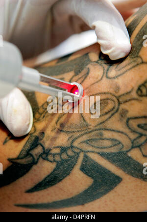 Tattoo Removal: Procedure, Benefits, Risks, Safety, Cost