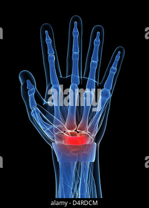 Highlighted carpal tunnel syndrome Stock Photo