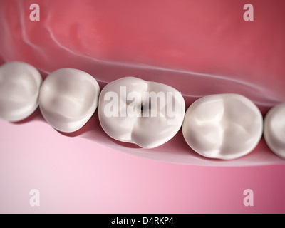 Tooth extraction - Wisdom teeth removal Stock Photo - Alamy
