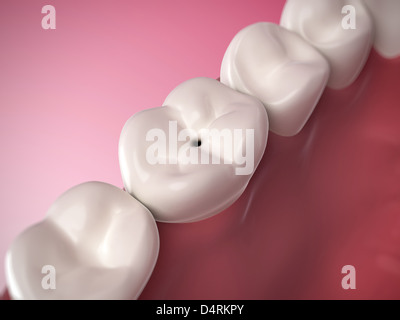 Tooth extraction - Wisdom teeth removal Stock Photo - Alamy