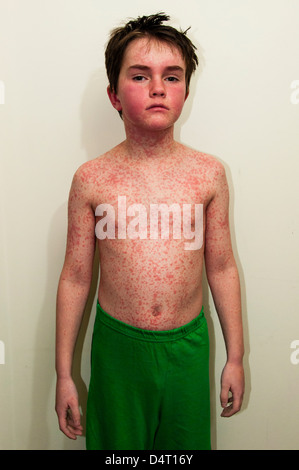 Young Boy With a Rash Caused by An Allergic Reaction Stock Photo