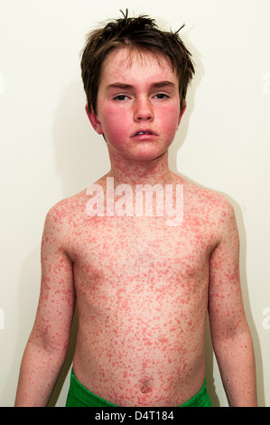 Young Boy With a Rash Caused by An Allergic Reaction Stock Photo