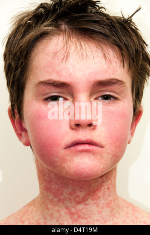 Young Boy With a Rash Caused by An Allergic Reaction Stock Photo