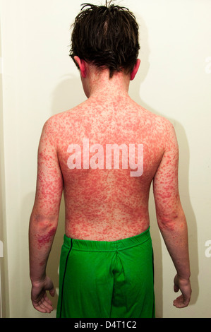 Young Boy With a Rash Caused by An Allergic Reaction Stock Photo