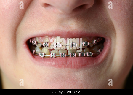 Braces, dental braces, close-up of teeth and braces, orthodontic braces Stock Photo