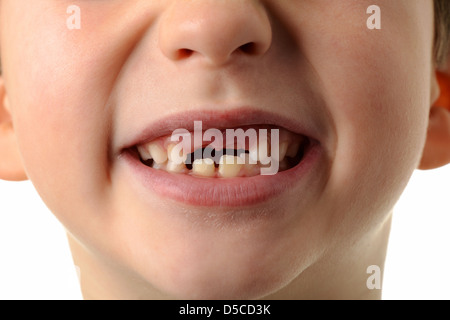 Child missing his two top teeth, close-up of mouth of boy showing his two top teeth missing. Stock Photo