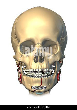 facial and fractures jaw multiple Disloacted