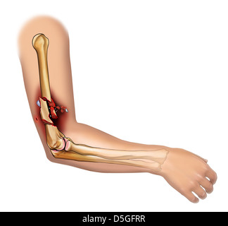 Comminuted Fracture of the Humerus Stock Photo - Alamy